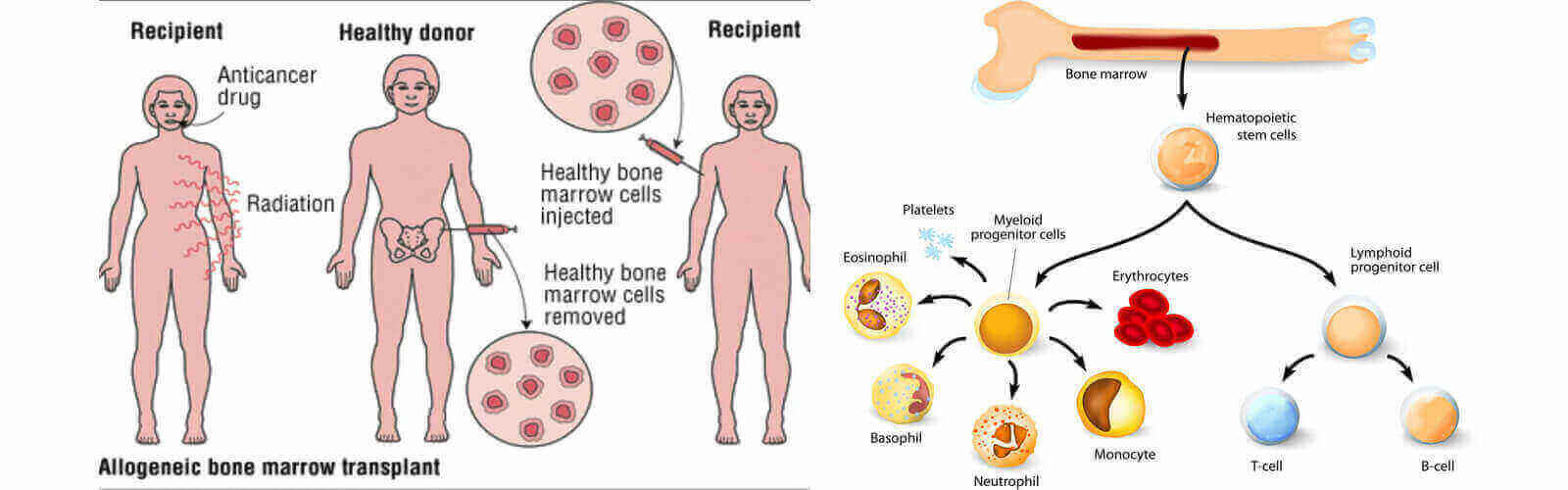 Bone Marrow Transplant in Thailand
