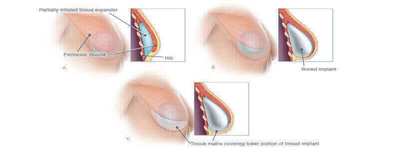 Breast Surgery in Kentucky