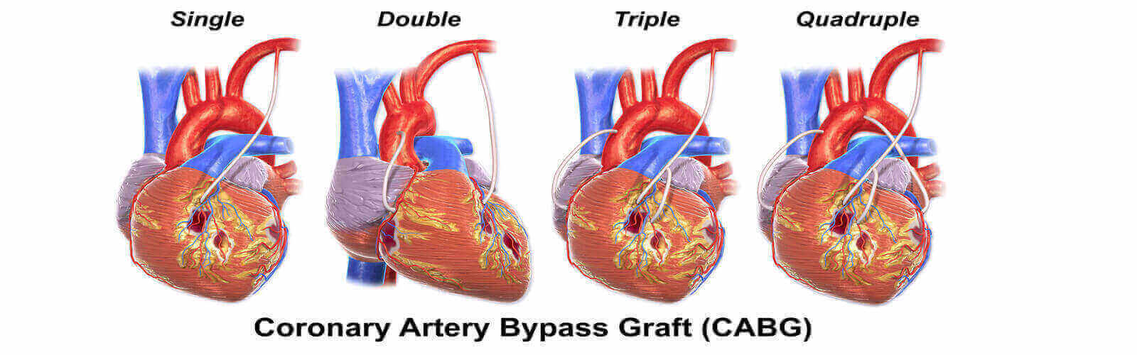 Coronary Artery Bypass Graft in Germany