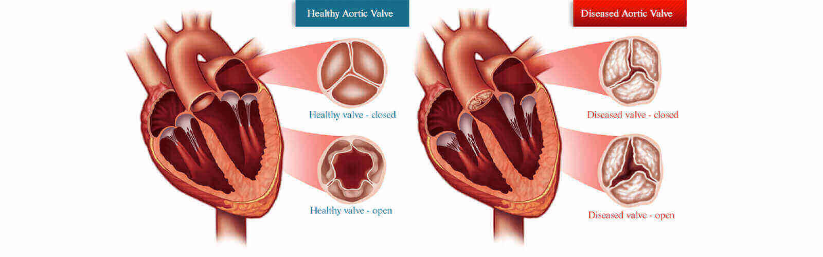 Heart Valve Replacement Surgery in Thailand