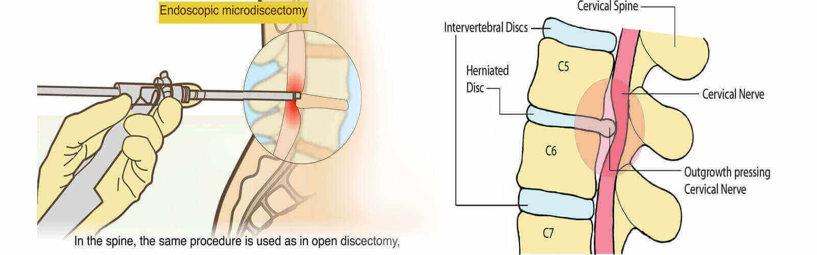 Herniated Disc Treatment in Thailand