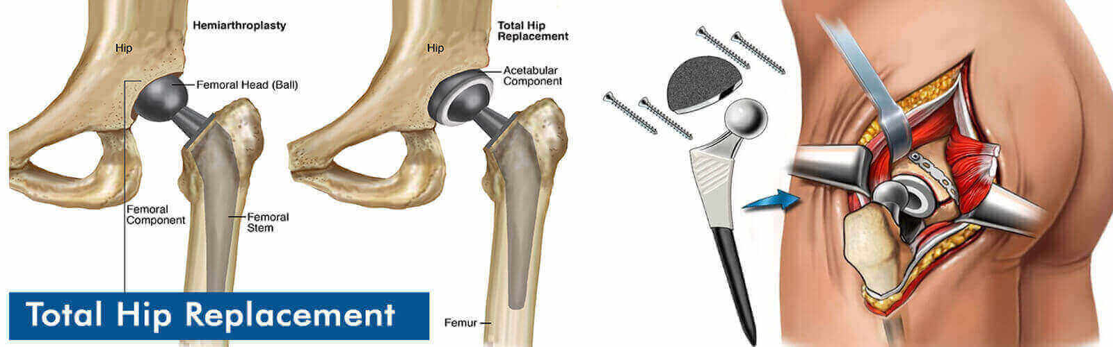 Hip Replacement Surgery Or Hip Resurfacing in Thailand