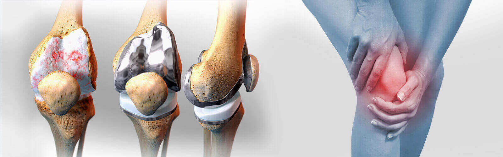 Knee Replacement Surgery in Thailand