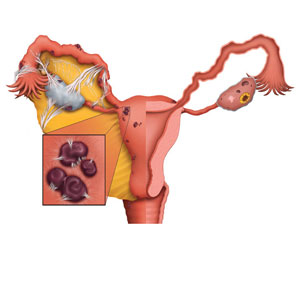 Endometriosis Surgery