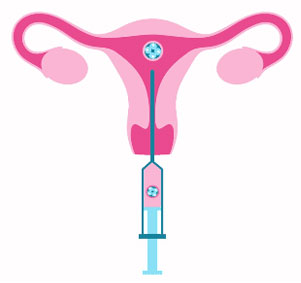 In Vitro Fertilization (IVF)