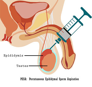 Testicular Sperm Aspiration (TESA)