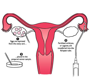 Zygote Intra-Fallopian Transfer (ZIFT)