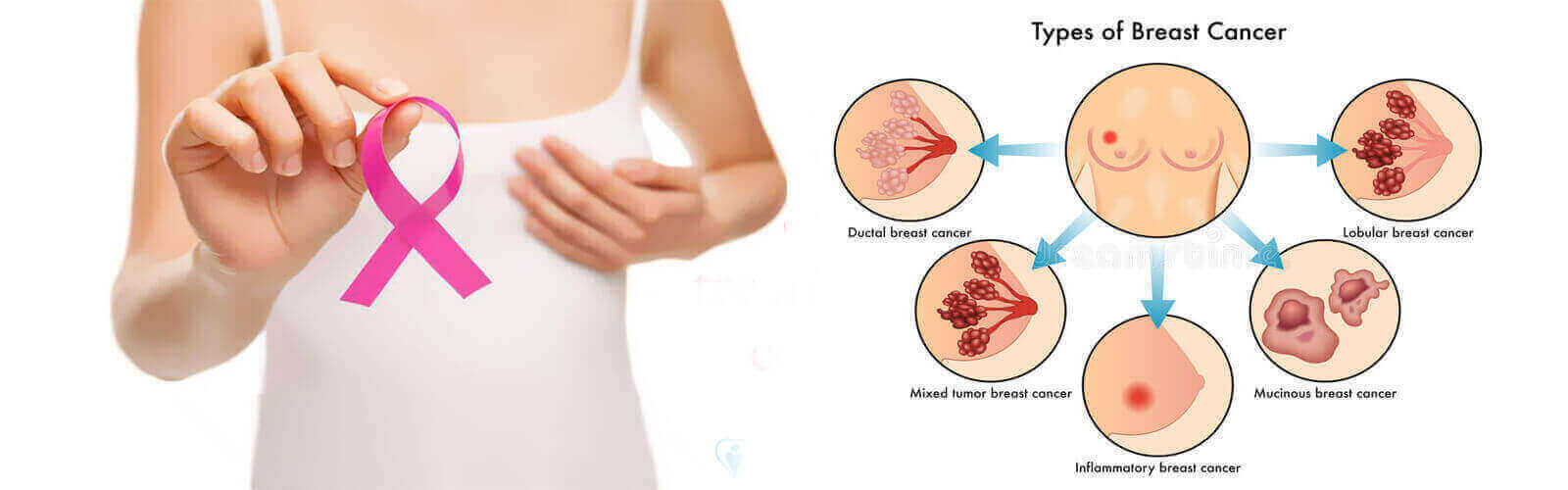 Breast Cancer Treatment in Vijayawada