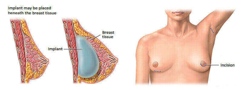 Breast Implant Surgery in Vijayawada