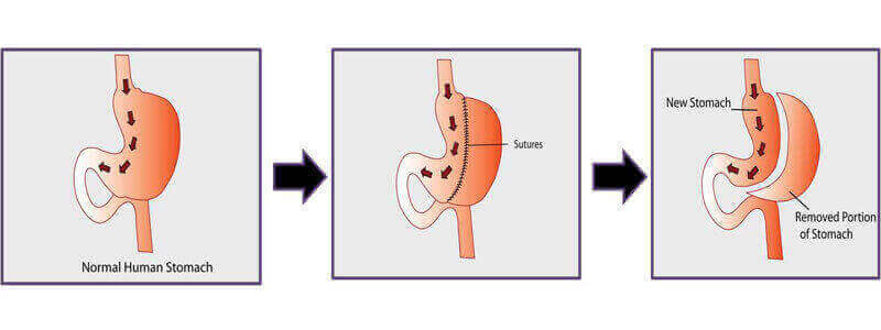 Gastric Sleeve Surgery in Vijayawada