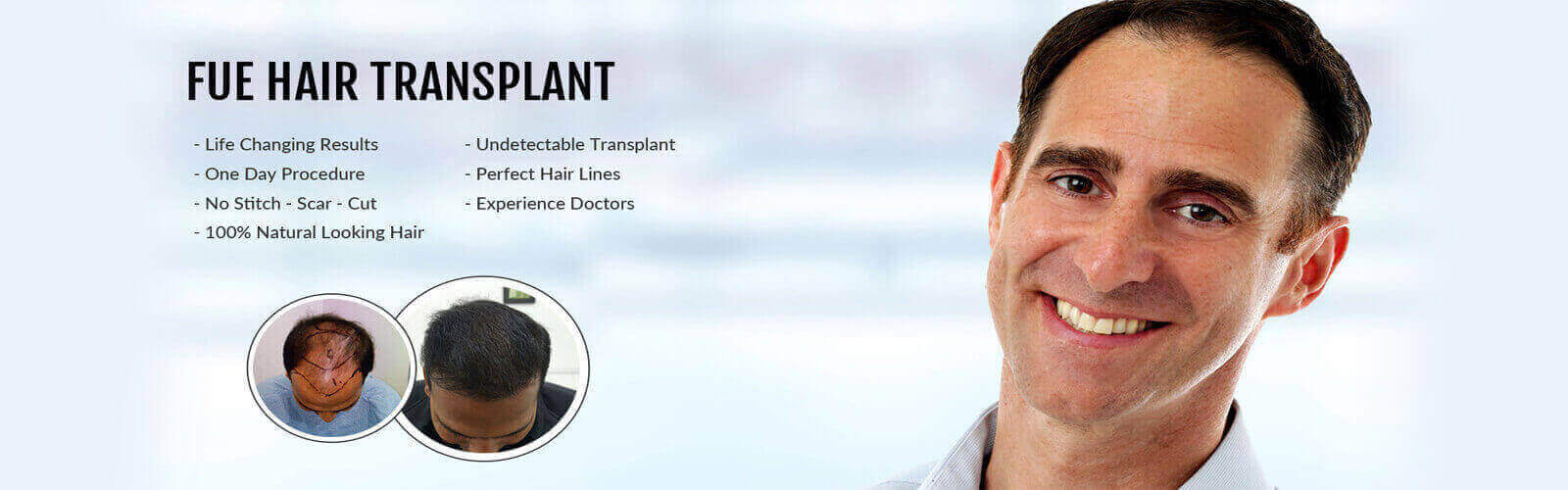 Hair Transplant in Vijayawada